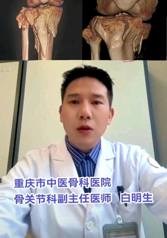 胫骨平台骨折术后康复