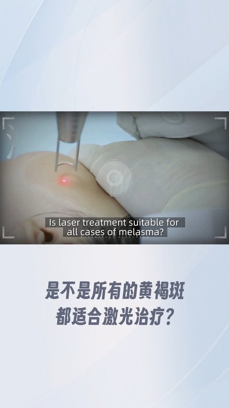 是不是所有的黄褐斑都适合激光治疗？