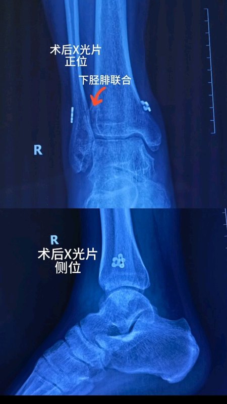 踝扭伤要注意排除下胫腓联合损伤