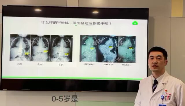 半椎体