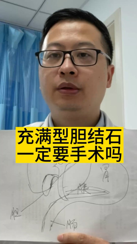 充满型胆结石一定要手术吗＃医学科普 ＃胆囊结石