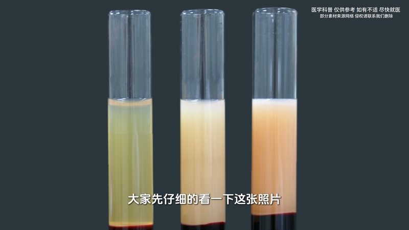 查出甘油三酯高，坚持做好这五点能救命