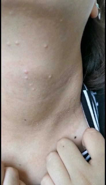 传染性软疣是这样的