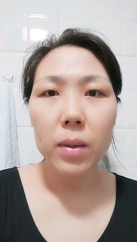 腓骨肌萎缩症能痊愈吗