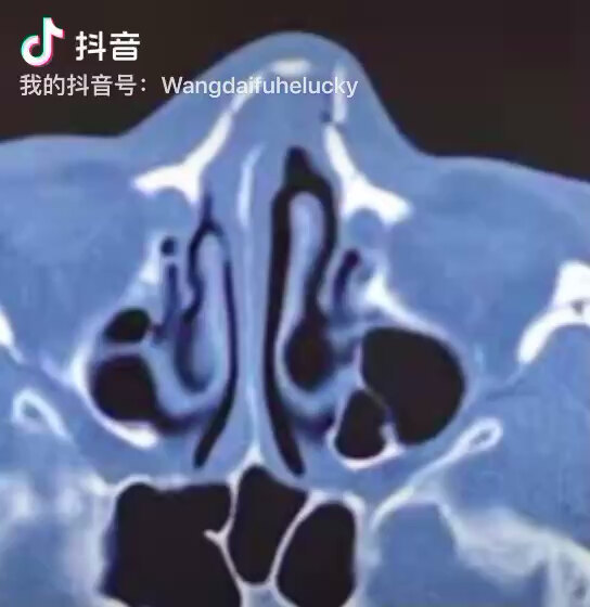 鼻骨骨折，需手术治疗