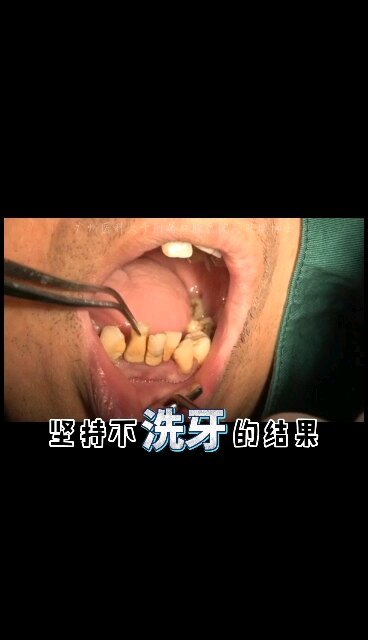 不洗牙，后果很严重