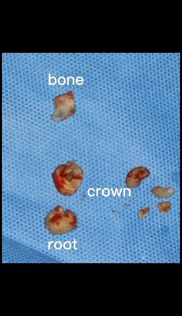 分块拔除埋伏阻生智齿