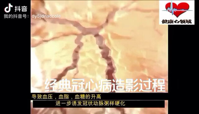 冠心病是中老年人常见的疾病，严重危害患者健康，甚至造成猝死等严重并发症。冠心病造影和支架植入治疗过程