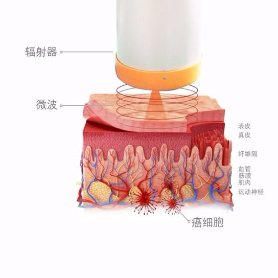 带您见证肿瘤深部热疗的神奇效果