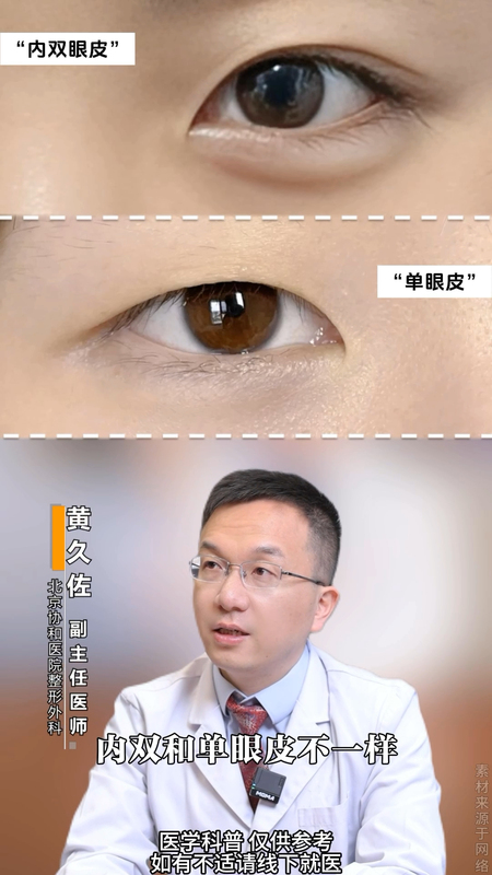 做成了“内双”算是失败的双眼皮吗？协和医生说：内双和单眼皮是两种不同结构！
