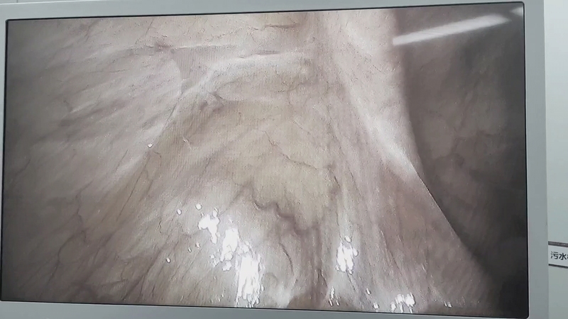 男，59岁，腹股沟鼓出一个包，腹股沟疝，腹腔镜腹股沟疝修补术，安全高效恢复快。