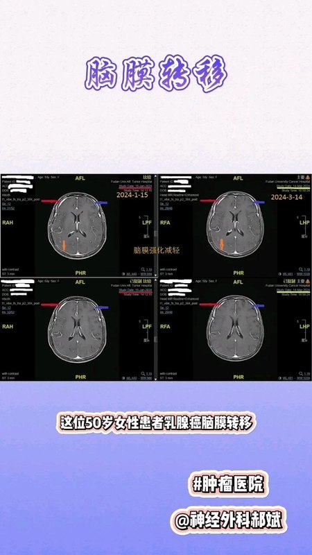 恶性肿瘤脑膜转移病例分享