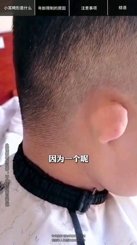 小耳畸形的耳再造有年龄限制吗？