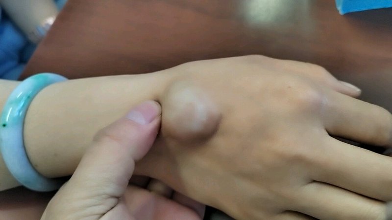 被挤压了多次的腱鞘囊肿！