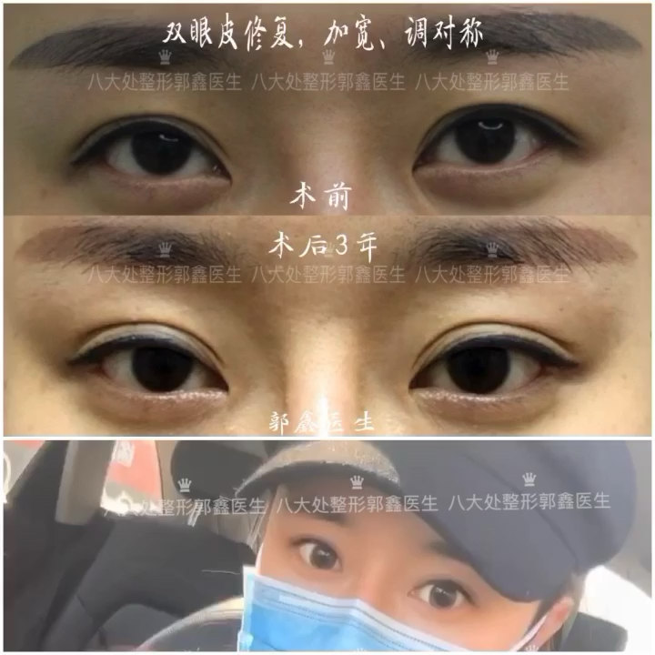双眼皮修复、加宽、调对称