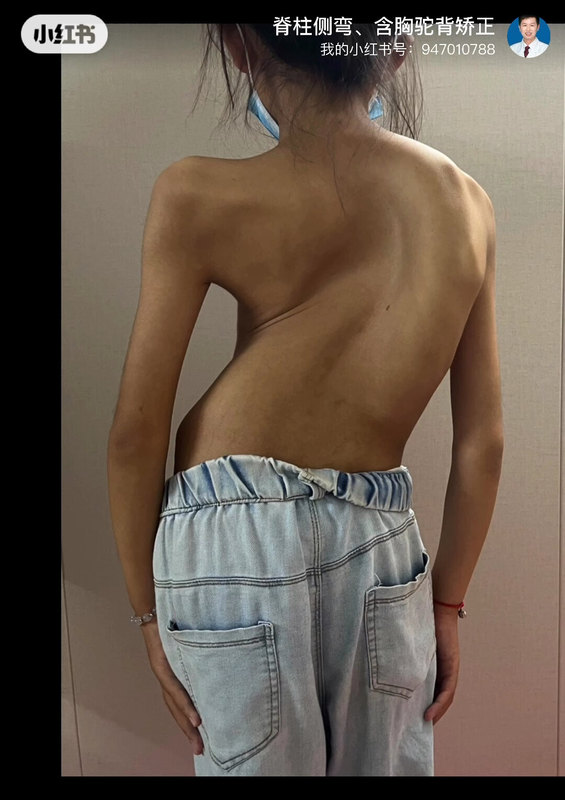 什么是脊柱侧弯