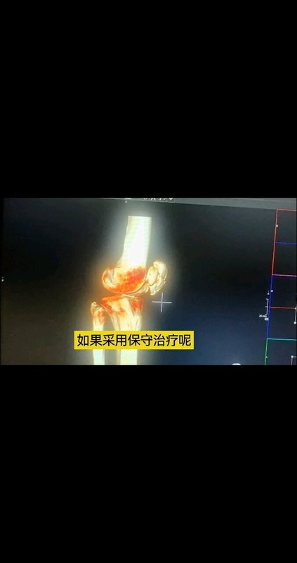 粉碎性髌骨骨折在手术后能取得什么样的疗效？