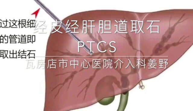 经皮经肝胆道穿刺。胆道镜取石
                            PTCS