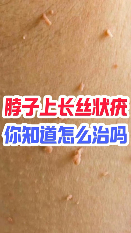 脖子上长了很多小疙瘩，是HPV病毒吗？