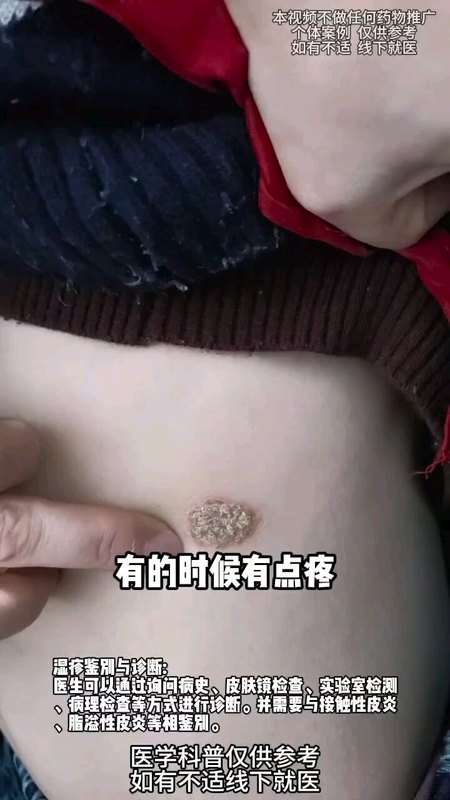 皮肤红斑脱皮是癣吗？
