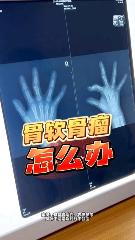 儿童骨软骨瘤需要手术吗？