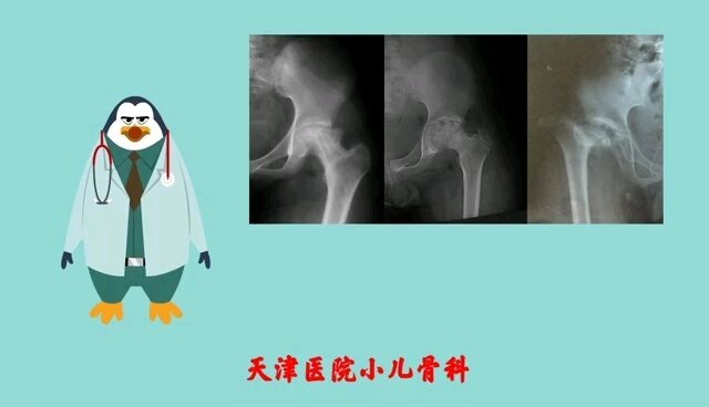 儿童股骨头坏死
