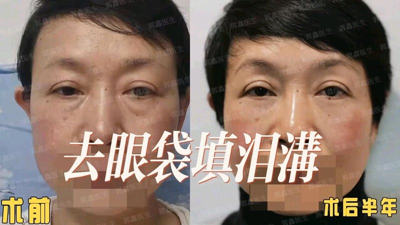去眼袋填泪沟术后半年