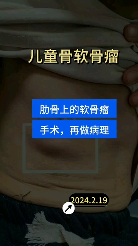 儿童骨软骨瘤是良性还是恶性