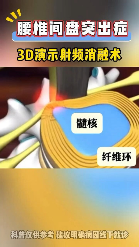 腰椎间盘突出——射频消融术演示