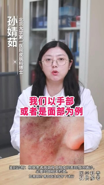 过敏性皮炎如何处理？