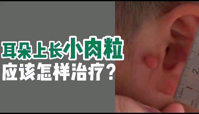 孩子耳朵上长了一颗小肉球，不要不在意，可以找医生切除
