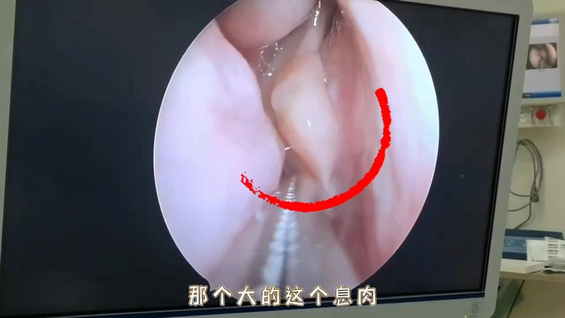 鼻息肉发现就应该手术，否则多受数年病痛困扰
