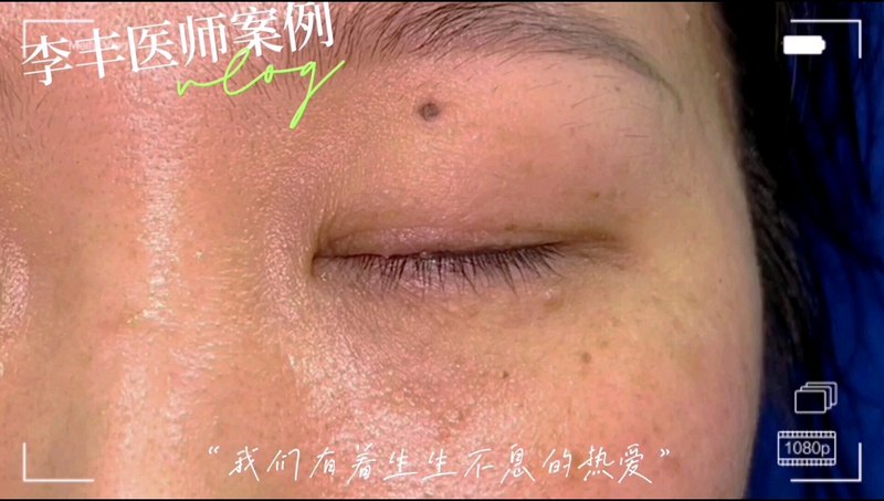 眼睑上的“肉肉”美学亚单位修复