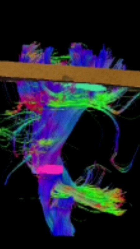 复发胶质瘤：位于运动区，术后肢体活动良好，全切肿瘤…