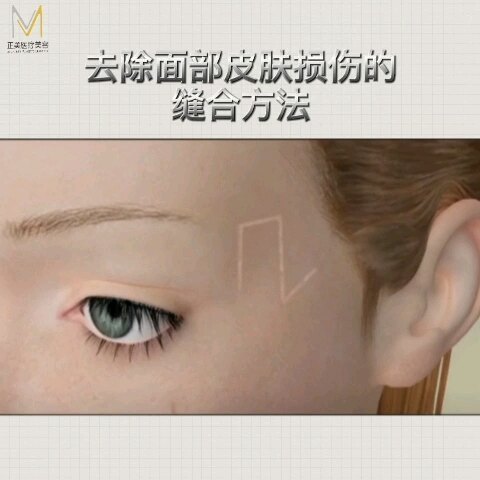 神奇的美容缝合