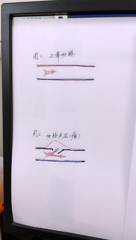 微创修复人体动脉夹层瘤