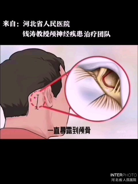 三叉神经痛、面肌痉挛开颅手术是怎么做的？（显微血管减压术）